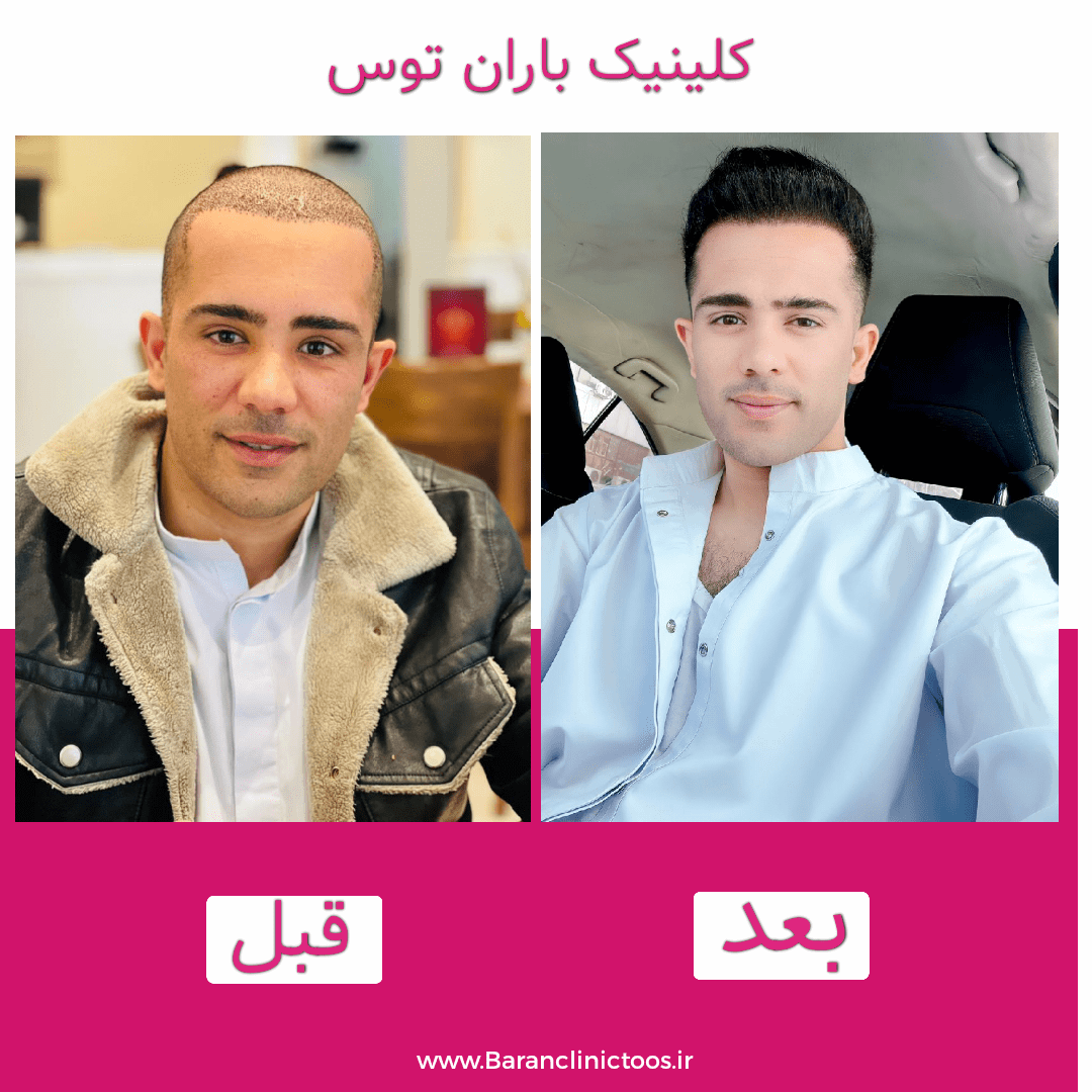 قبل و بعد کاشت مو